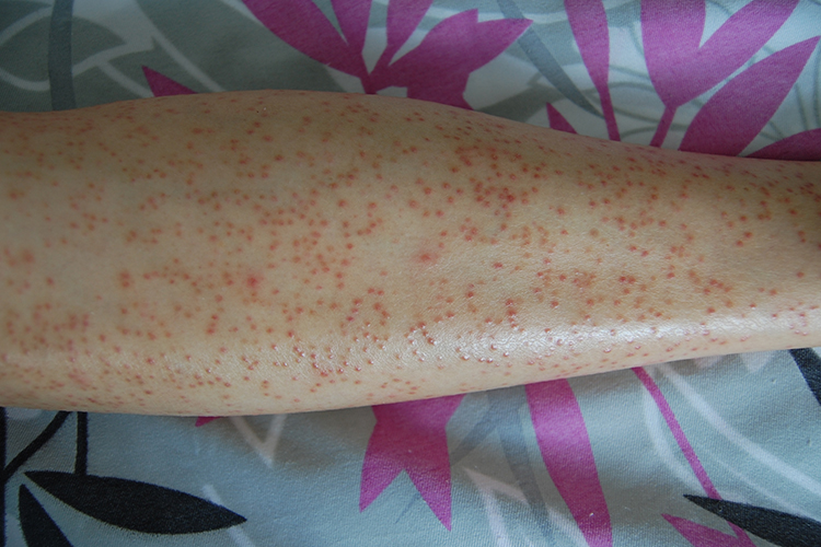 毛发红糠疹红色丘疹图