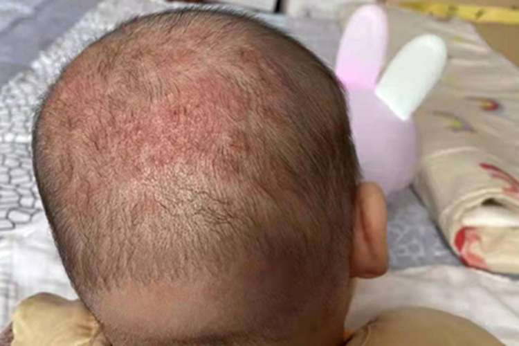 婴儿脂溢性皮炎头皮症状图