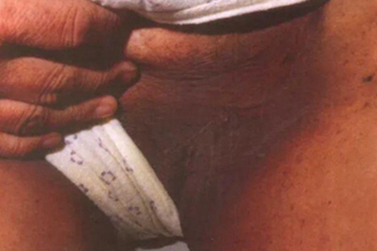 恶性黑棘皮病大腿皮肤发黑图