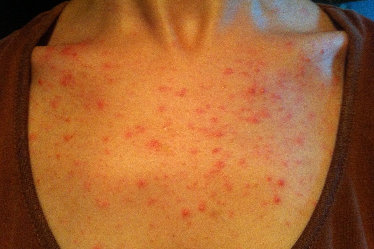 急性皮肤型红斑狼疮胸部红点图