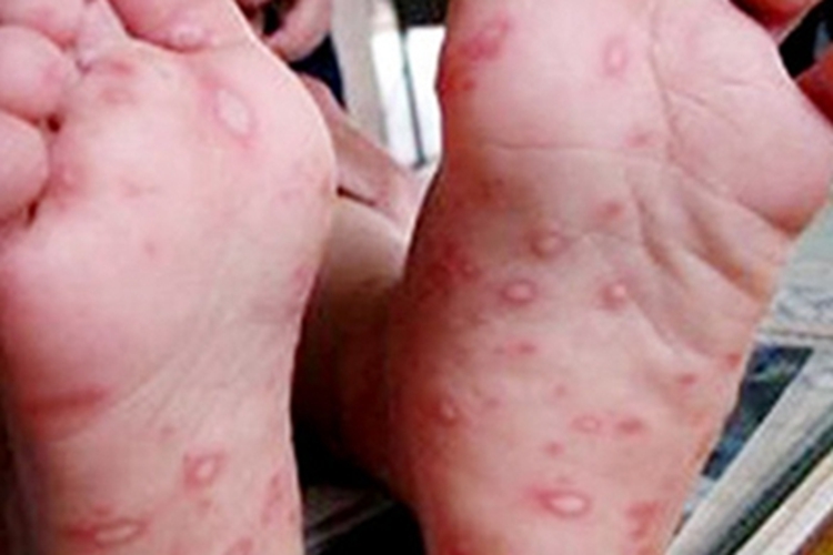 手足口病脚底症状图