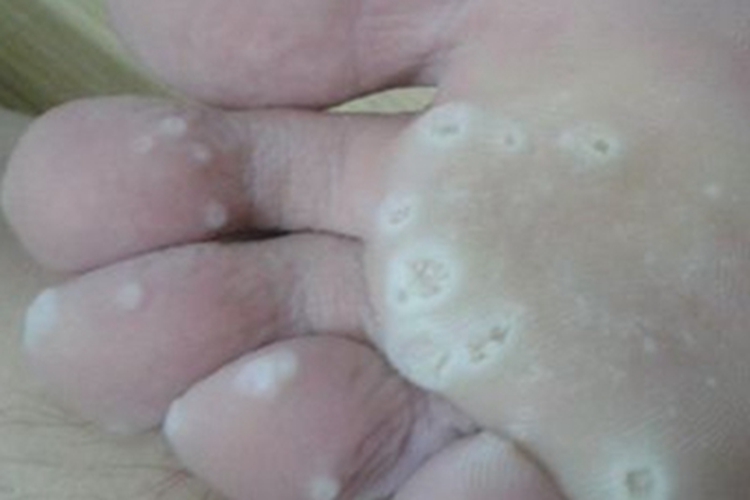 水疱型足癣脚底起小白疱图