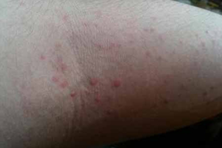水源性荨麻疹胳膊小红疙瘩图