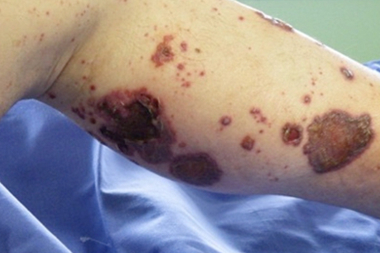 儿童结节性多动脉炎小腿溃疡图 儿童结节性多动脉炎小腿溃疡图