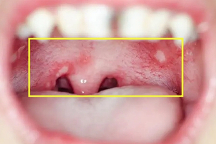 黏膜损害可发生在咽后壁,临床可表现为局部出现轻微凸起的灰白色白斑