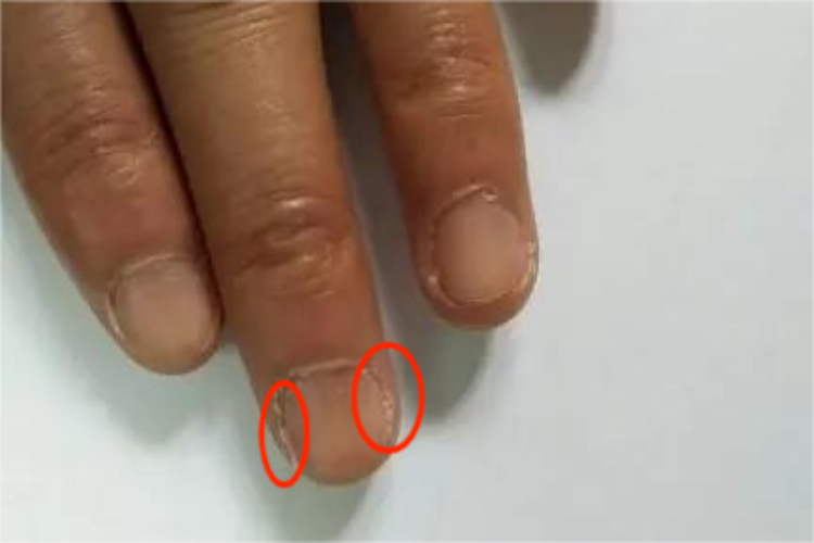 指甲两边长硬角质图