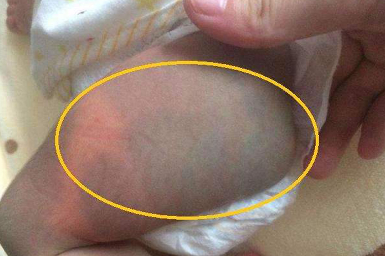 新生儿蒙古斑图