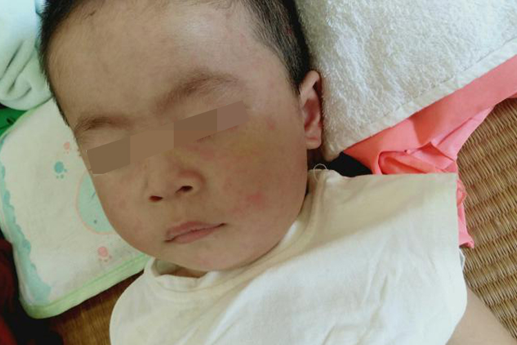 发烧后脸上起幼儿急疹图 发烧后脸上起幼儿急疹图