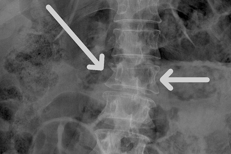 l1腰椎压缩性骨折图