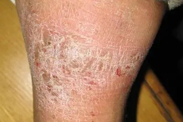 冬季瘙痒症小腿裂纹图