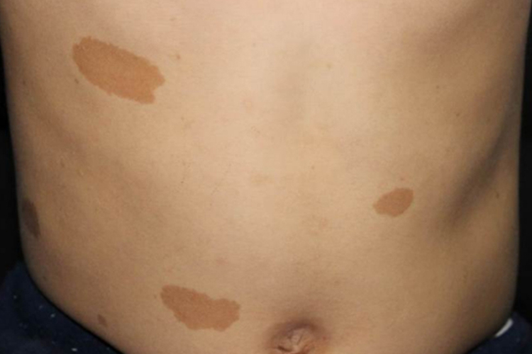 典型的神经纤维瘤咖啡斑图 典型的神经纤维瘤咖啡斑图