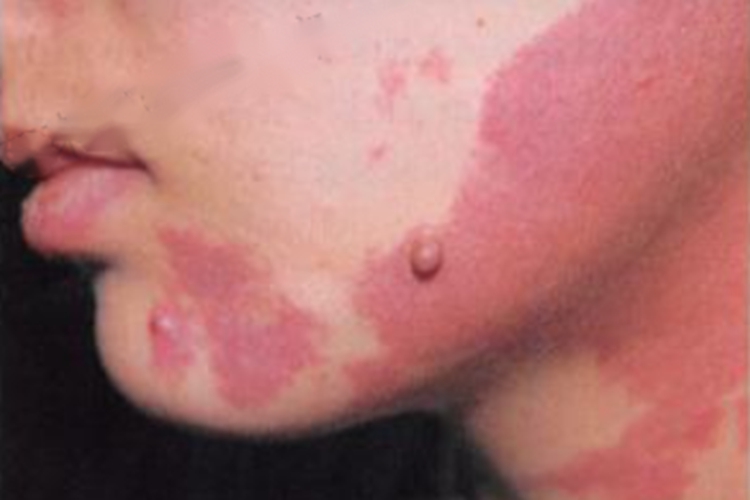 女性脉管畸形图