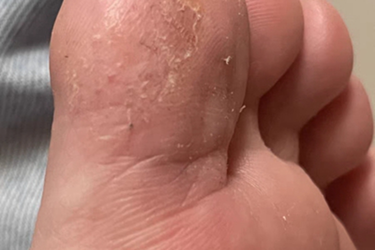 汗疱疹脱屑图 汗疱疹脱屑图