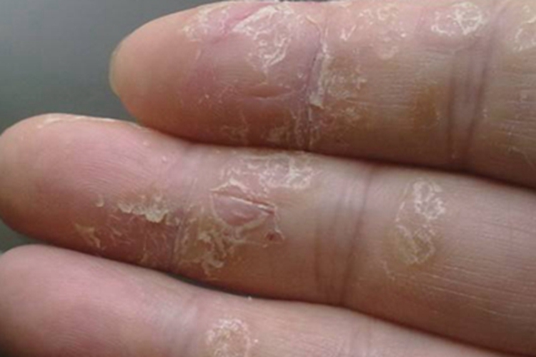 点状掌跖角化病手指脱皮图