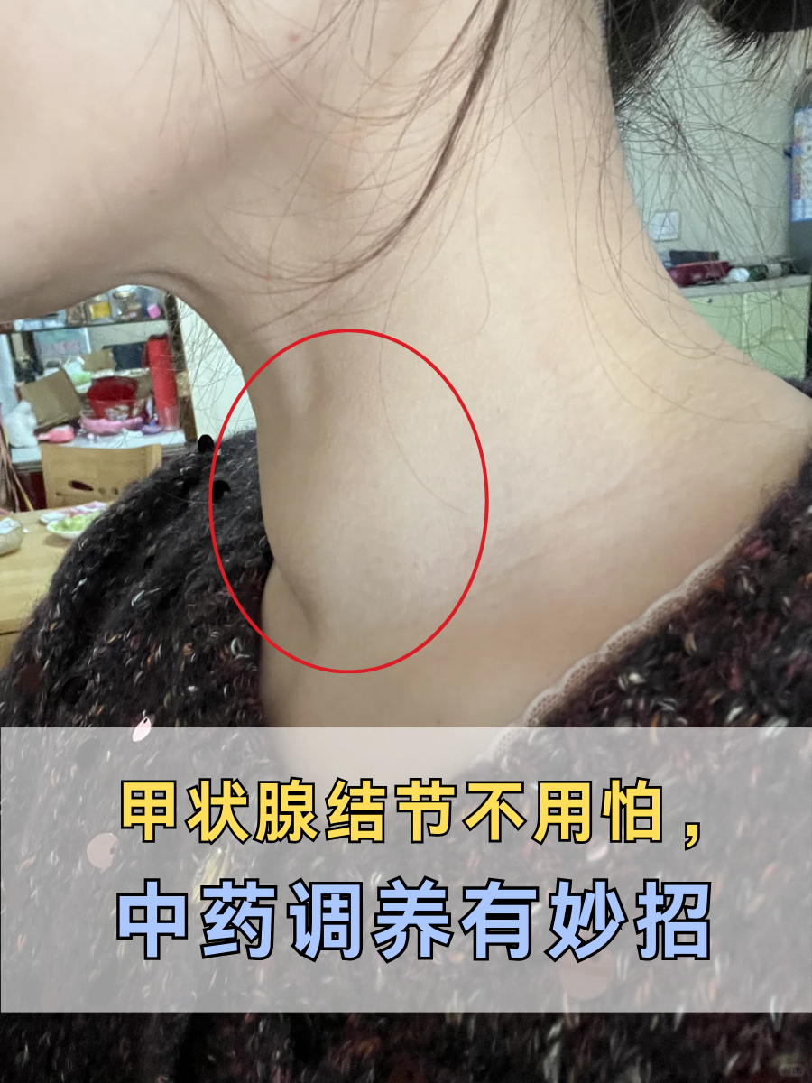 甲状腺结节不用怕，中药调养有妙招