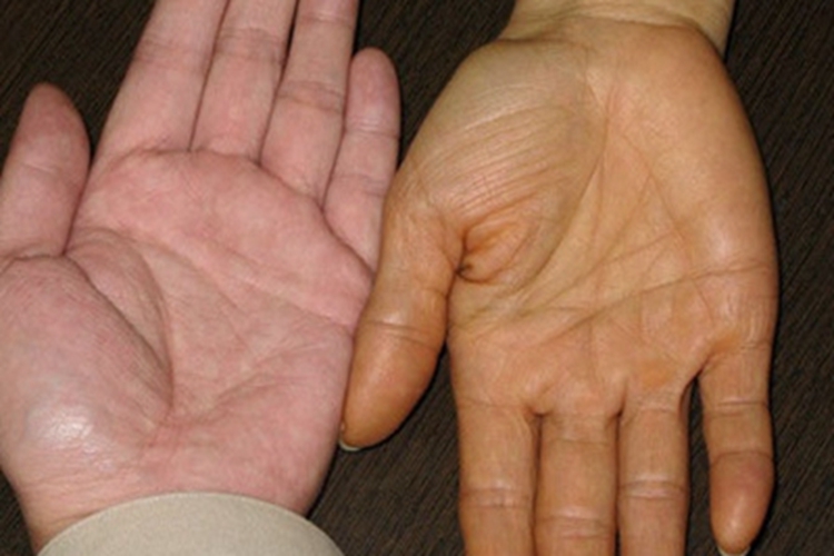 胡萝卜素血症手掌发黄干燥图