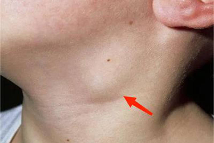 费尔蒂综合征前颈肿块图