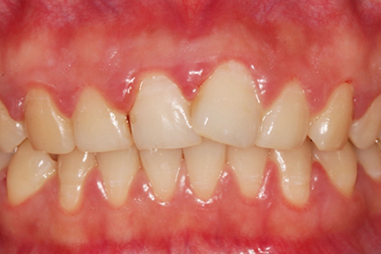 牙龈炎牙龈水肿图