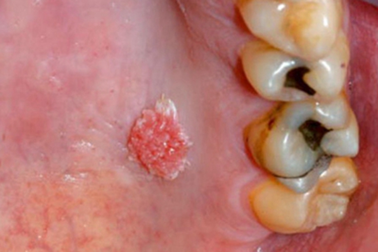 口腔尖锐湿疣口腔症状图
