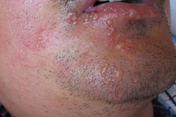 下颌支带状疱疹图