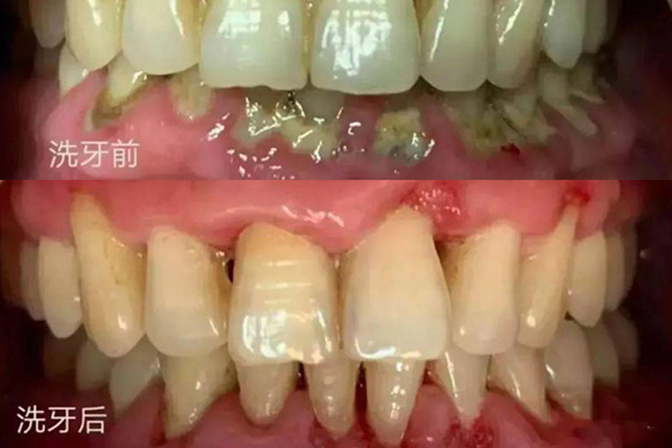 龈上洁治术前后对比图 龈上洁治术前后对比图