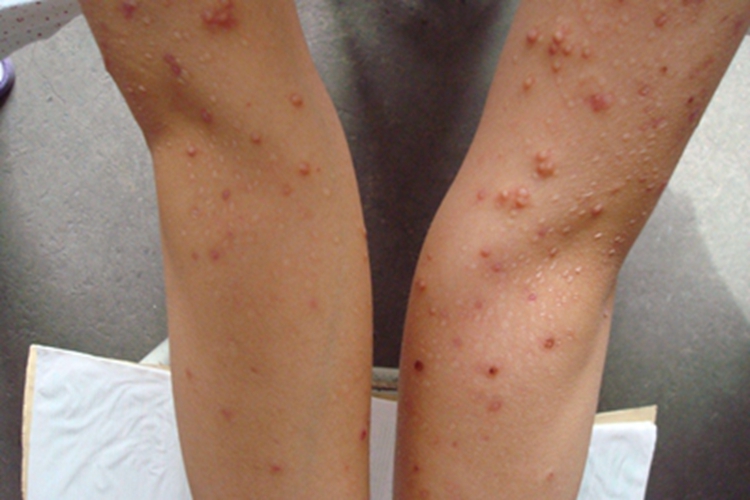 急性痘疮样苔藓样糠疹小红疙瘩图 急性痘疮样苔藓样糠疹小红疙瘩图