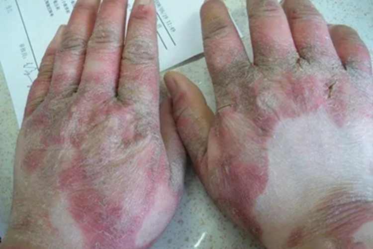 可变性红斑角化病手部症状图
