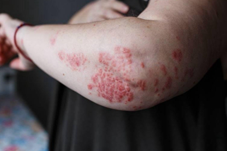 湿疹肘部丘疹图 湿疹肘部丘疹图