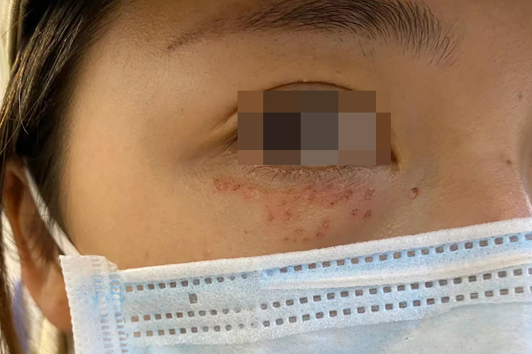 激光治疗后创面干燥图