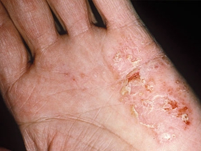 关于湿疹的图片及症状图片