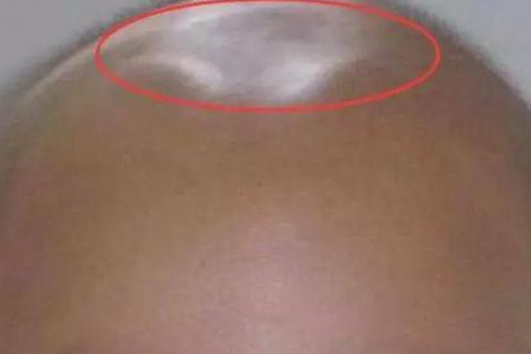 宝宝前囟未闭图 宝宝前囟未闭图