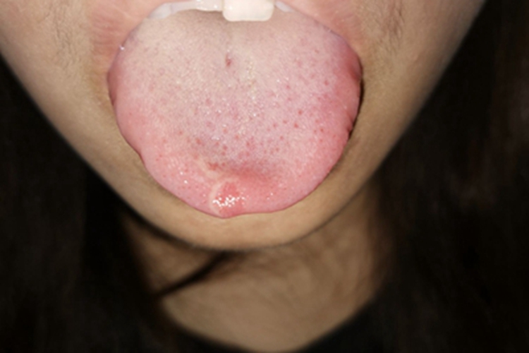 地图舌舌尖两块小红斑图 地图舌舌尖两块小红斑图