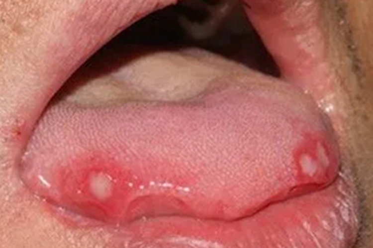 溃疡性口炎舌头白斑图