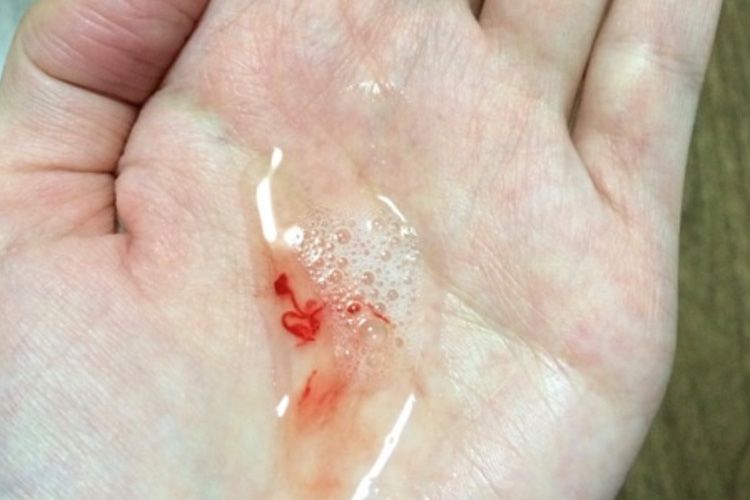 肺结核痰中带血图