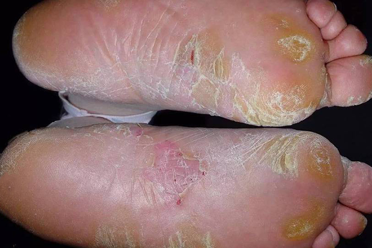 浸渍糜烂型足癣图