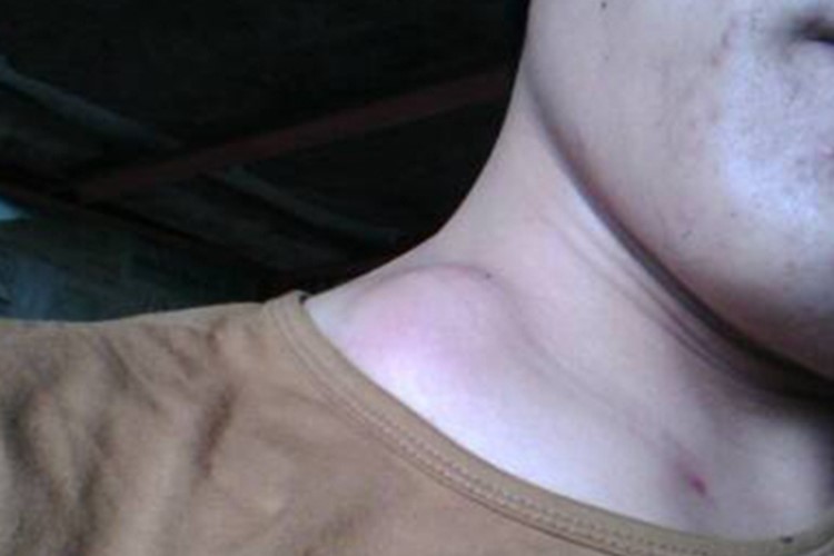 锁骨嗜酸性肉芽肿图