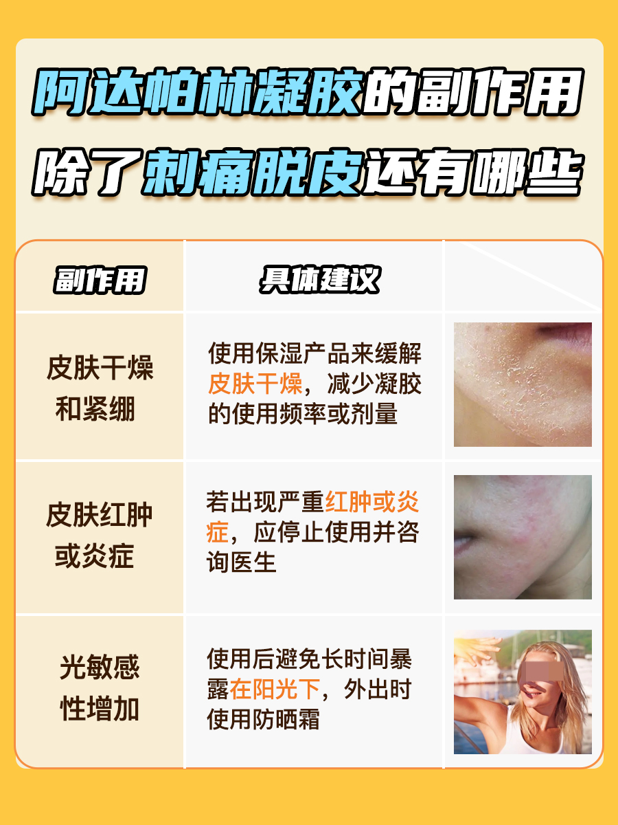 阿达帕林凝胶副作用:脸干刺痛脱皮怎么办?