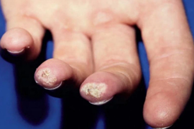 皮肤钙质沉着症手指尖症状图