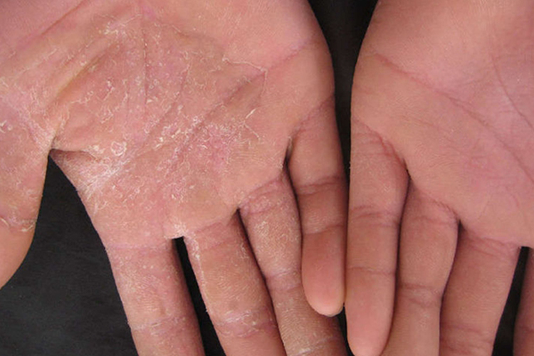 鳞屑角化型手癣图