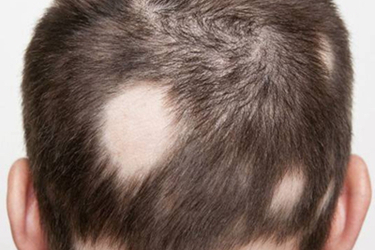 假性斑秃症状图