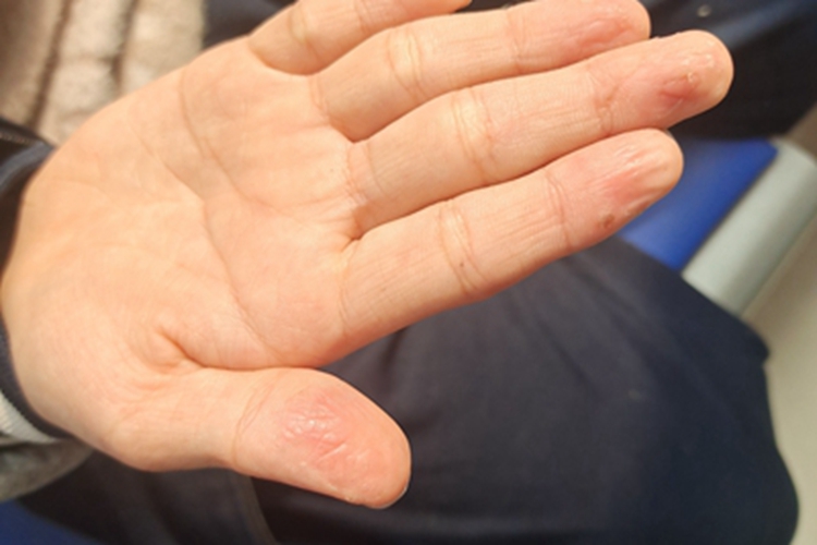 剥脱性角质松解症手指皱缩有纹图