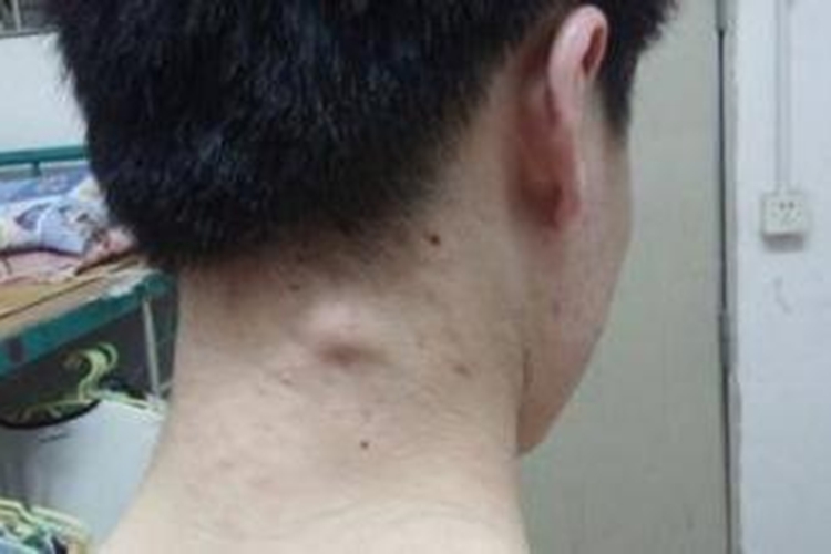 脖子皮脂腺囊肿图