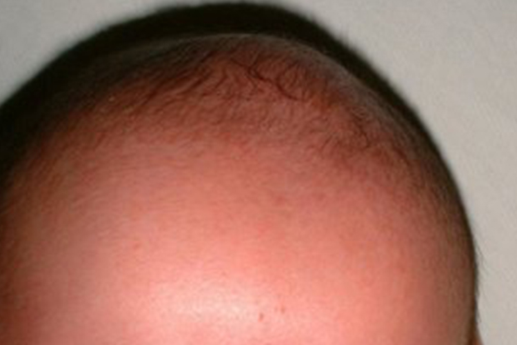 婴儿囟门发红图 婴儿囟门发红图