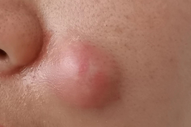 皮脂腺囊肿面部症状图