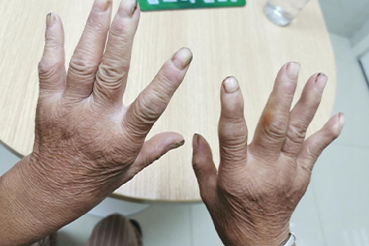 类风湿关节炎手指关节症状图