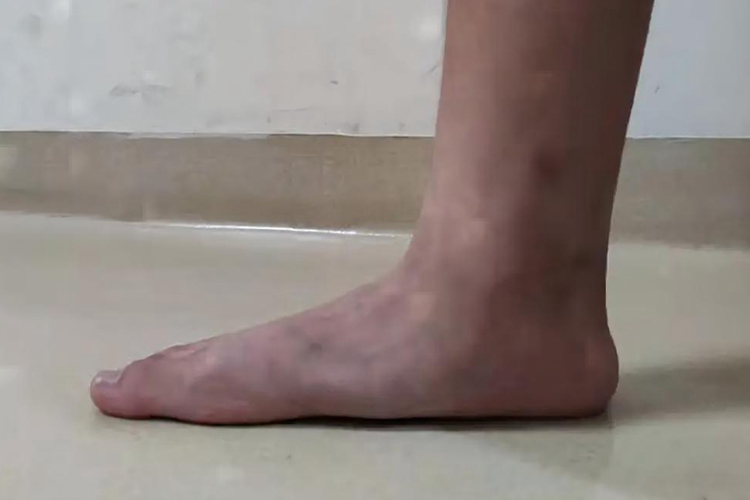 扁平足图