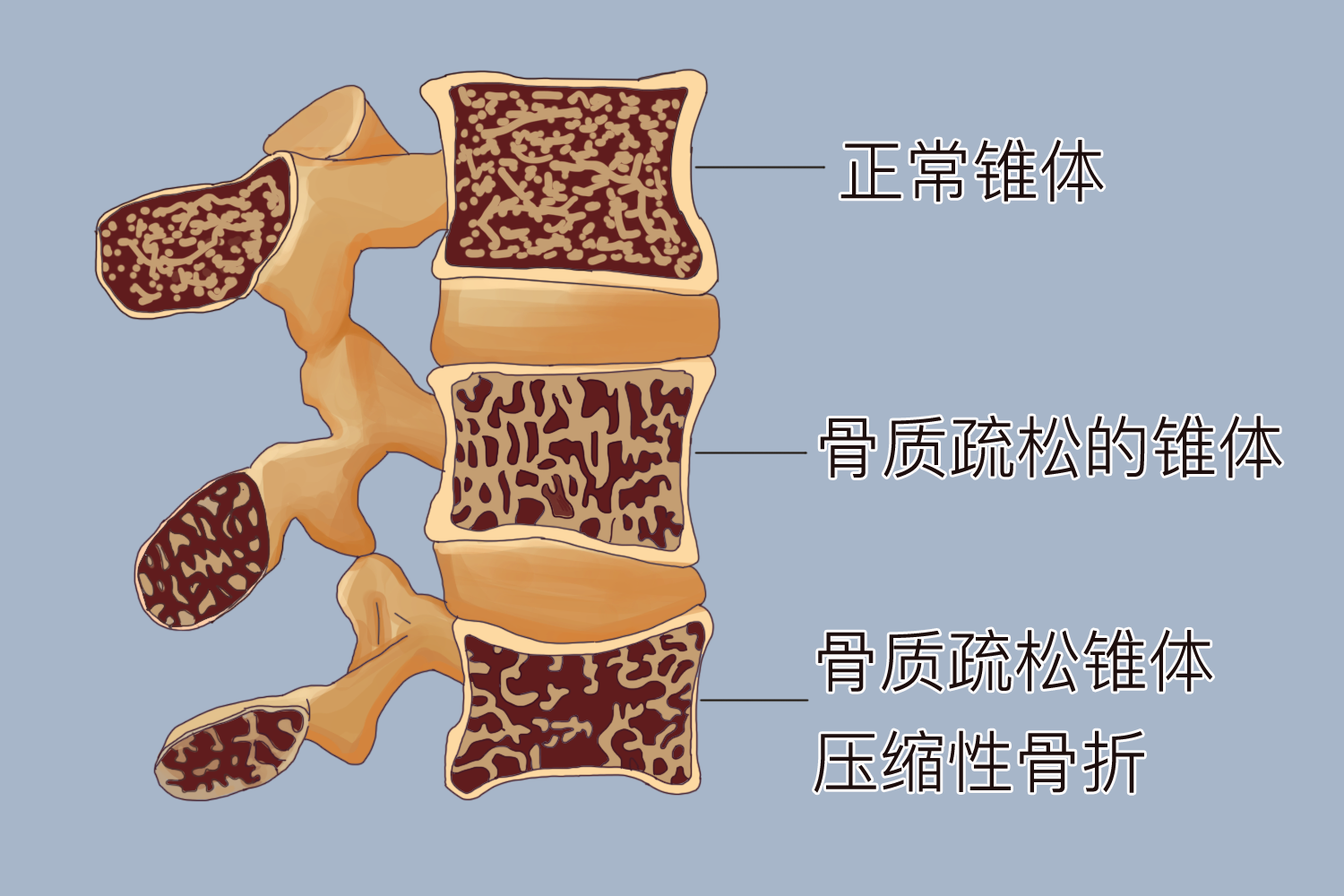 椎体骨质疏松图