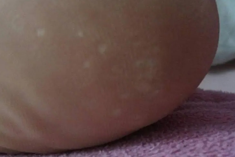 皮肤干燥致脚后跟白点图