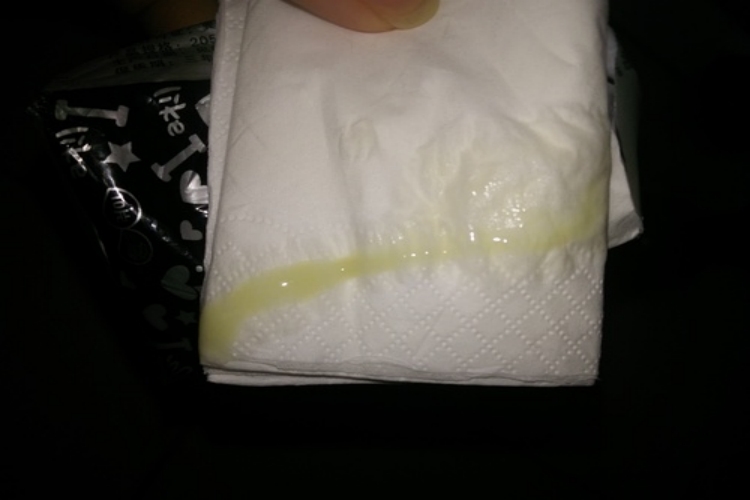 子宫颈炎绿色分泌物图