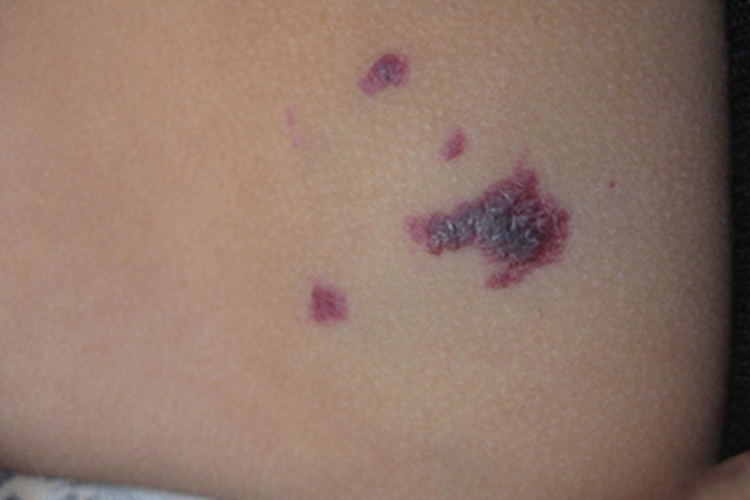 局限性血管角皮瘤大腿紫斑图 局限性血管角皮瘤大腿紫斑图